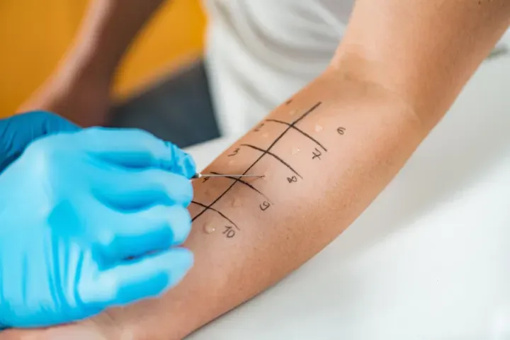 Allergologo a Roma - Allergologia al Sanismart Medical Center