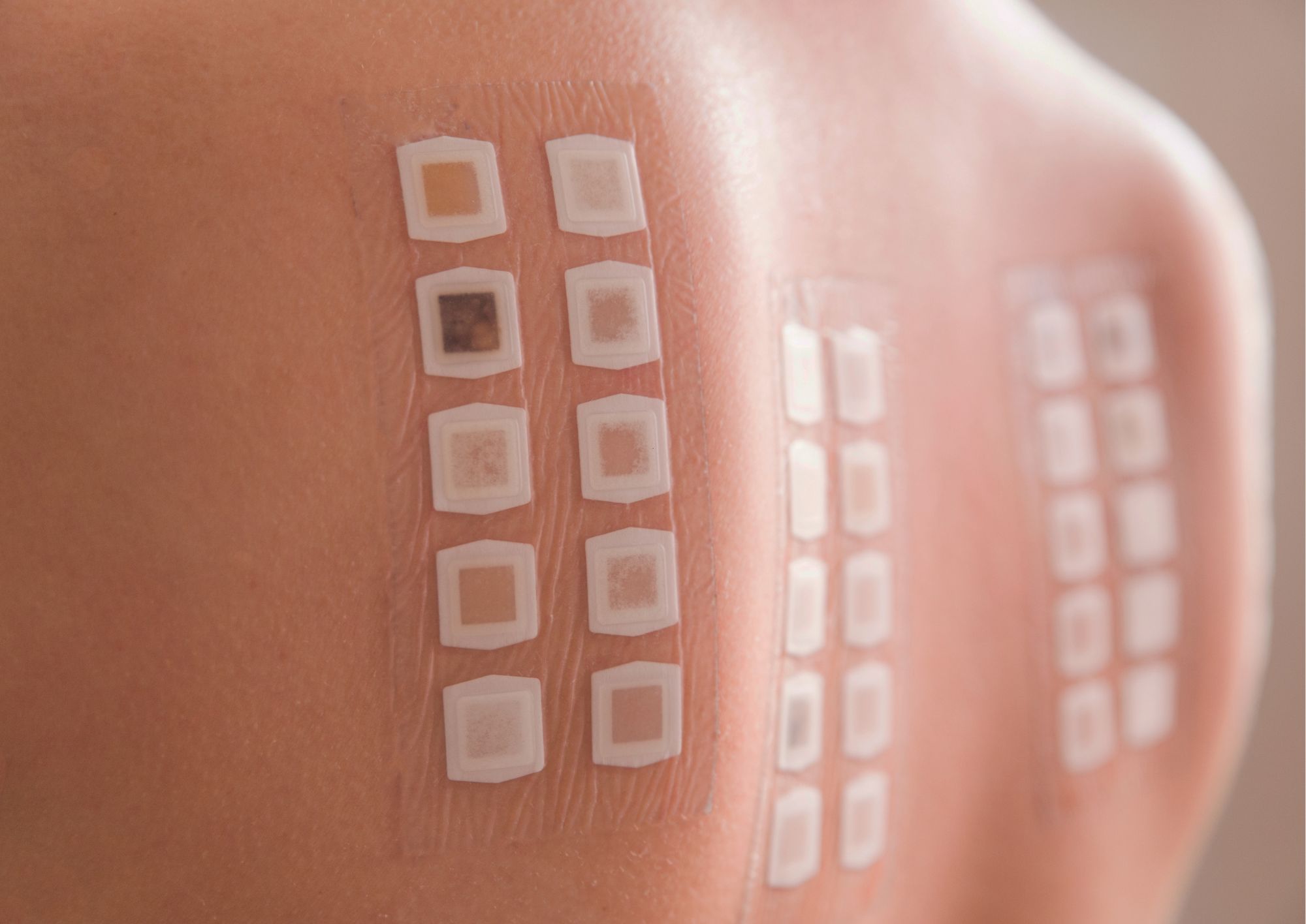 Patch test: esame dermatologico per diagnosticare allergie da contatto, identificare sostanze responsabili di dermatiti e reazioni cutanee.