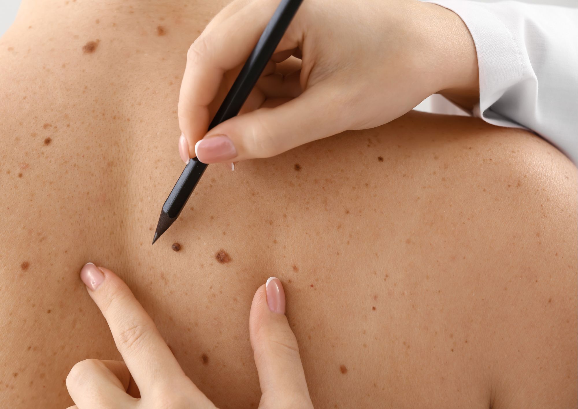 Rimozione di neo: procedura ambulatoriale per asportare lesioni cutanee pigmentate, valutare modifiche sospette e supportare la diagnosi dermatologica.
