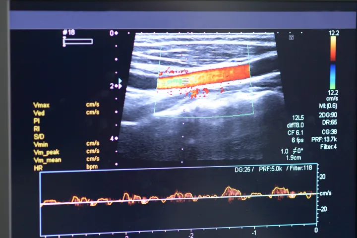 Scopri cos'è lo screening vascolare, chi dovrebbe farlo, quando iniziare e quali sintomi non bisogna ignorare.