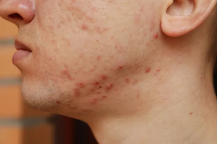 Perché si forma l'acne? Scopri le vere cause, sfata i miti più comuni e scopri i trattamenti dermatologici più efficaci.