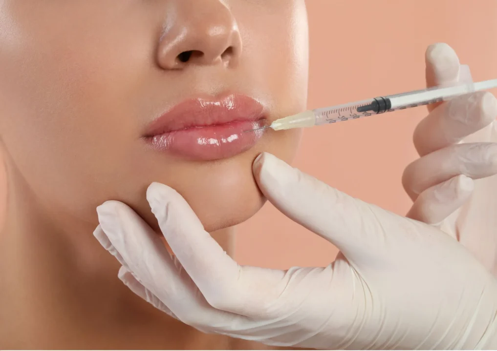 Trattamento filler labbra a Roma al Sanismart Medical Center